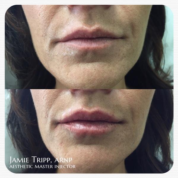 1 syringe Juvederm Vollure to lips, immediately after treatment