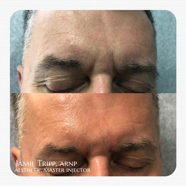 1/2 syringe Juvederm Vollure between brows, immediately after treatment