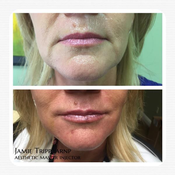 1 syringe Juvederm Vollure to lips and corners of mouth, 2 weeks after treatment