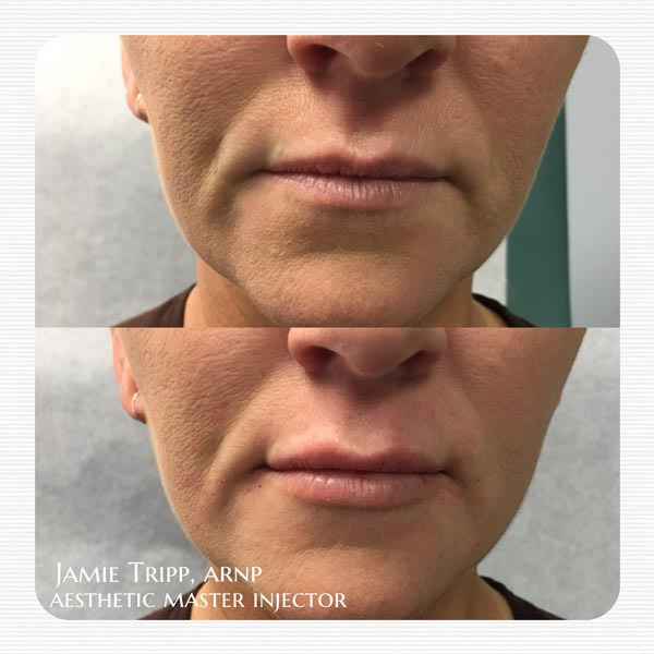 1/2 syringe Juvederm Volbella to lips, immediately after treatment