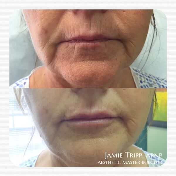 1 syringe Juvederm Vollure to lips and 1 syringe Juvederm Ultra plus to smile lines, immediately after treatment