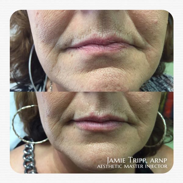 1 syringe Juvederm Vollure to lips, immediately after treatment