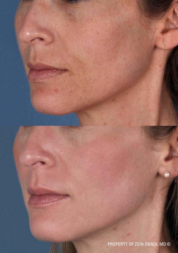 ZO Skincare Before and After 1