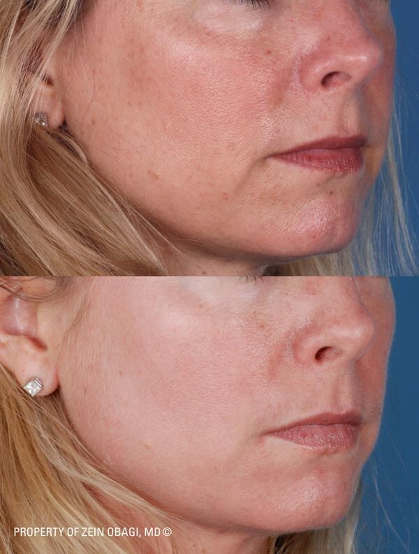 ZO Skincare Before and After 2