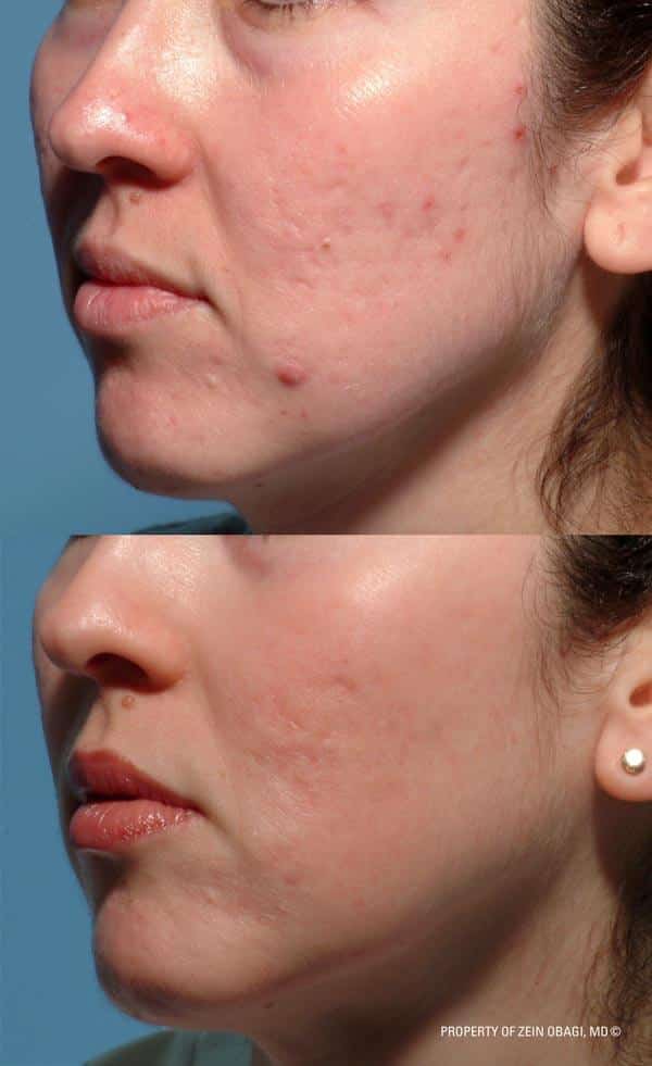 ZO Skincare Before and After 3