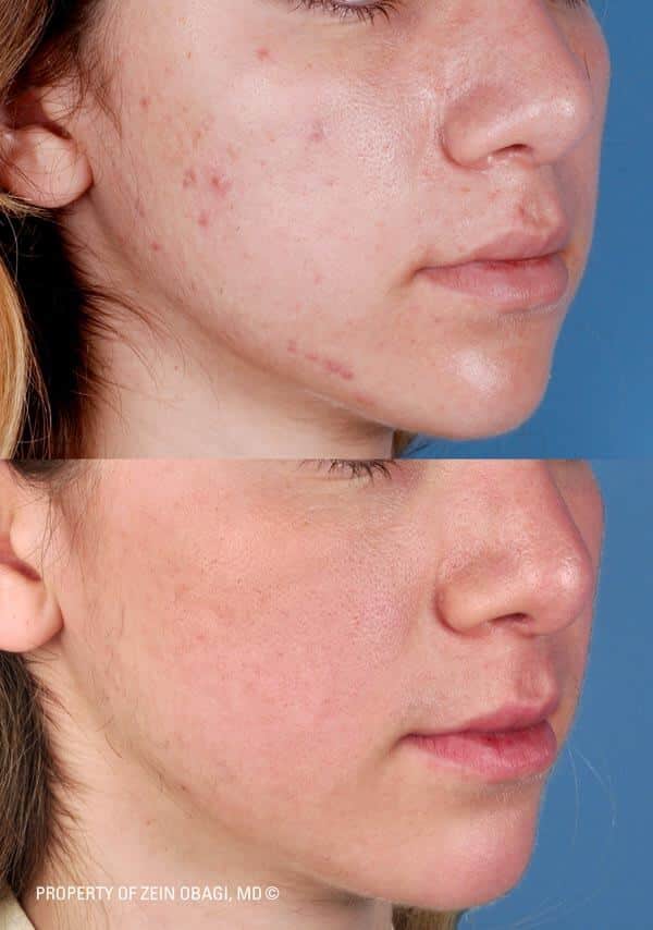 ZO Skincare Before and After 6