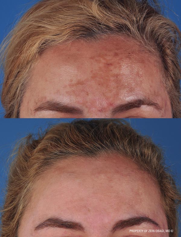 ZO Skincare Before and After 9