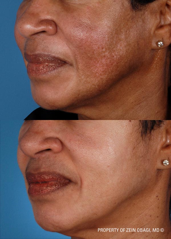 ZO Skincare Before and After 8