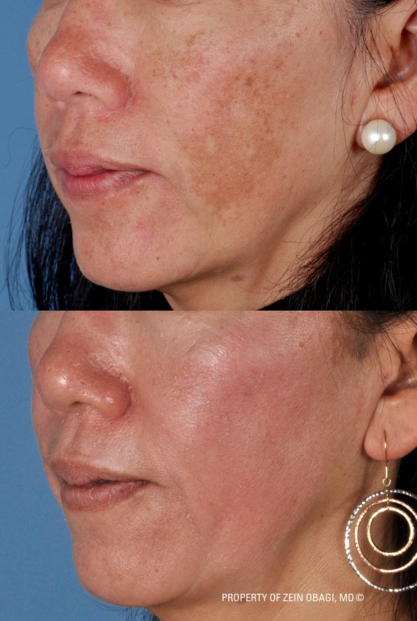 ZO Skincare Before and After 10