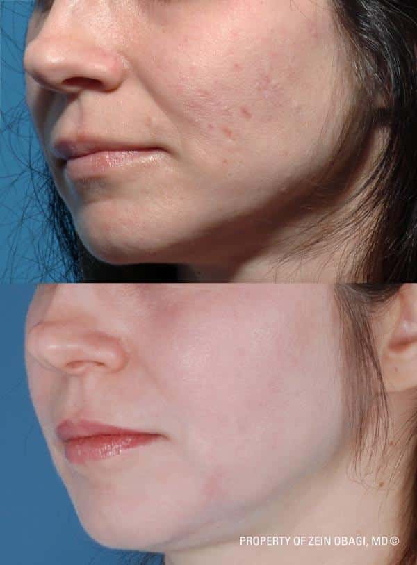 ZO Skincare Before and After 13