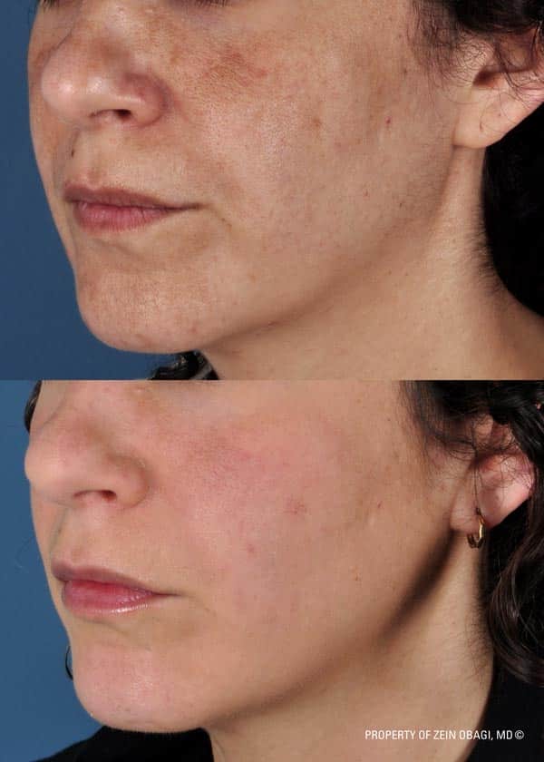 ZO Skincare Before and After 18