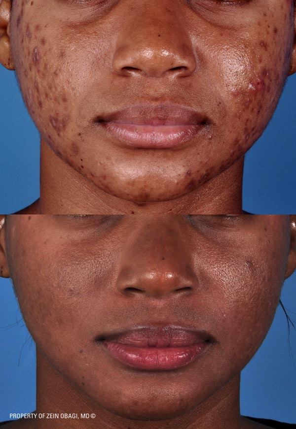 ZO Skincare Before and After 23
