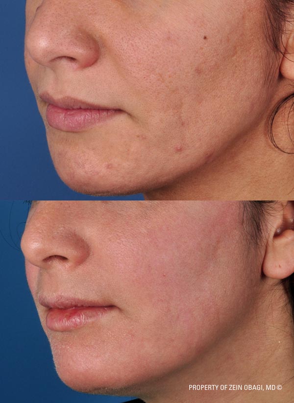 ZO Skincare Before and After 30
