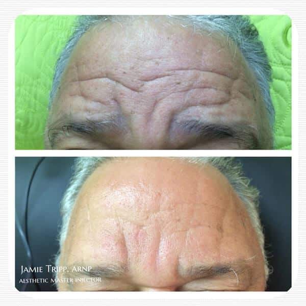 Botox Before and After 3