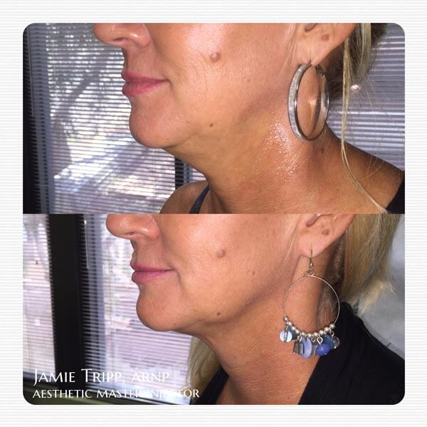 Kybella Before and After 3